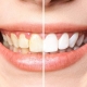 strahlend weiße Zähne im neuen Store von Konzept WEISS